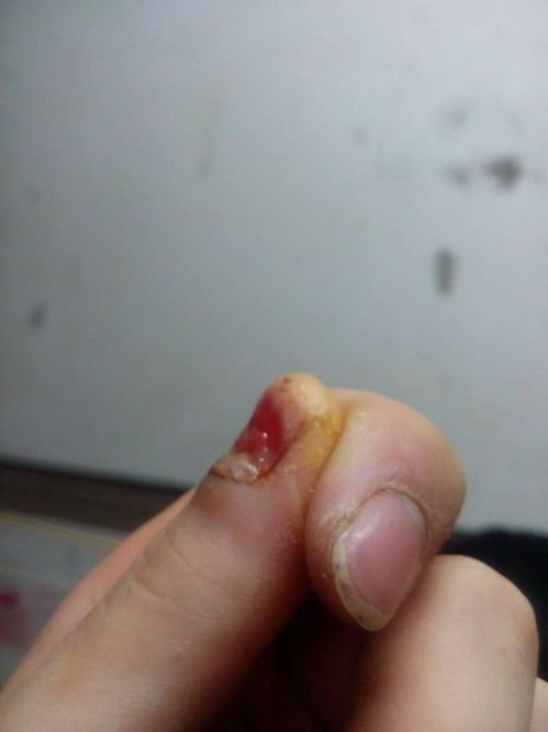 甲床受伤长出增厚型畸形指甲图片