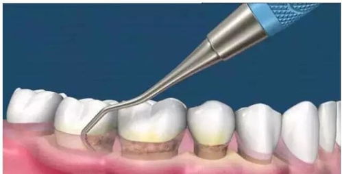 普通洗牙和龈下刮治有什么区别 疼吗