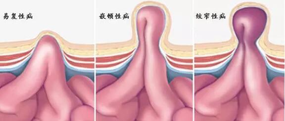 勿以 疝 小而不为 52岁患者疝气数年仍在拖,忽然嵌顿险丧命