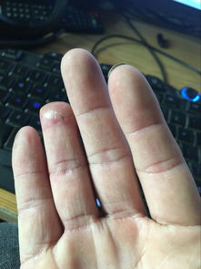 我的右手无名指 工伤 现在断了一个指甲那么多 评级 能评上吗 