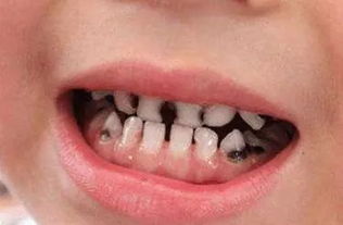 10岁男孩靠假牙吃饭 因为听说 乳牙坏了不用治,换了恒牙就好了