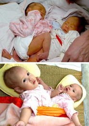 两对连体女婴同时住进医院接受治疗 