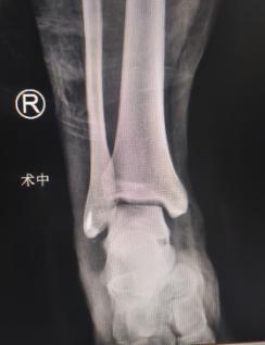 蹦下楼梯男生右踝骨折,医生关节镜下 微切口 复位骨折修复韧带