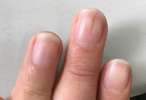 胃癌早期指甲的图片图片