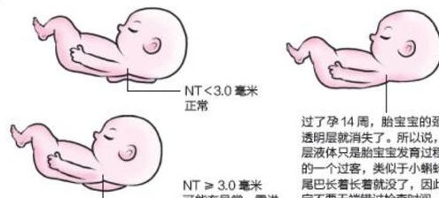 NT检查不通过孩子很危险,很多孕妇不知道NT检查是什么