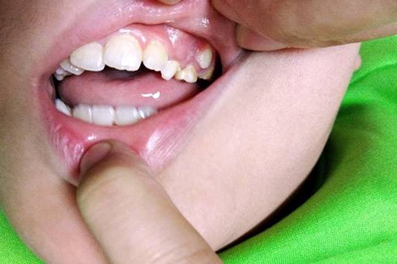 孩子嘴里长了 双排牙 背后原因有二,多半是父母造成的