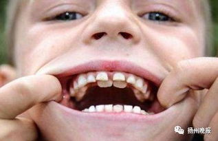 6岁孩子长出 双排牙 ,竟和家长的这个习惯有关 