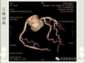  冠脉lcx是什么意思,什么是冠脉LCX ? 钱包应用