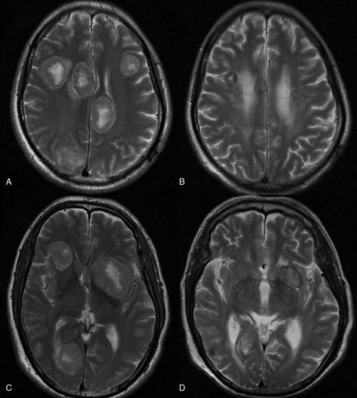 精彩案例分享 ALK脑 脑膜转移危急病情成功逆转