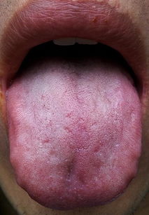 舌苔厚白是怎么回事 应该吃什么药