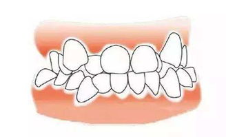 广州柏德口腔医院如何 牙齿不齐可以从小预防吗