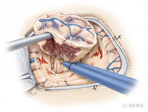 幕上海绵状血管畸形 附Spetzler Aaron教授精彩讲课视频 The Neurosurgical Atlas全文翻译