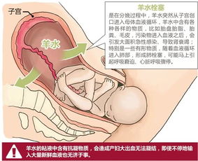 孕妇怎么预防羊水赛栓 孕妇如何避免羊水栓塞