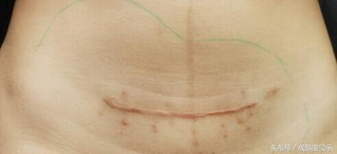 剖腹产疤痕：从手术刀痕到美丽疤痕的转变