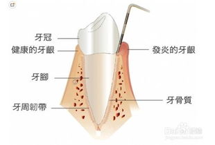 牙龈出血是什么原因 