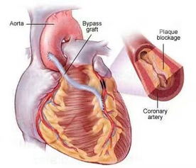 冠脉搭桥 主动脉瓣置换 二尖瓣成型术 原创 