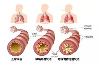 支气管哮喘症状 支气管哮喘的症状有什么