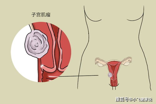 子宫肌瘤的 帮手 发现了,是2种常见食物,平时少往餐桌上摆放