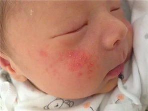 婴儿湿疹为什么反复的起老不好,小孩湿疹反反复复老不好怎么办?