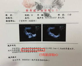 怀孕七周做B超无胎心,别着急,可能是受精卵着床晚,再等等