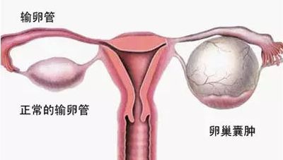 多囊卵巢综合征有什么症状？何军琴中医