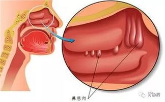 肠息肉 胃息肉 胆息肉 鼻息肉 子宫息肉 切还是不切