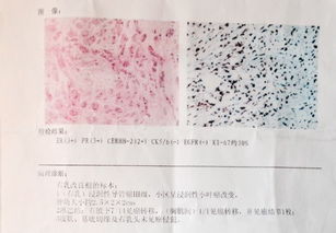 麻烦看看我妈妈的乳腺癌病理报告,非常感谢 