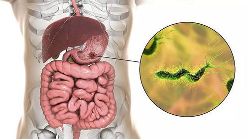 幽门螺杆菌可能引起胃溃疡 幽门螺杆菌没那么可怕,该怎么防治