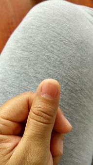 就是图中指甲盖上有一条线那个地方,指甲和肉之间有个小缺口,会长白色角质和指甲一起长出来的,指甲盖一 
