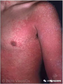 猩红热，一种被忽视的儿童疾病