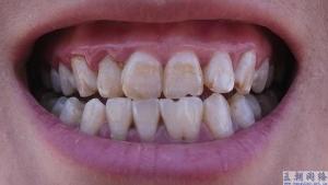 牙齿黄是什么原因造成的