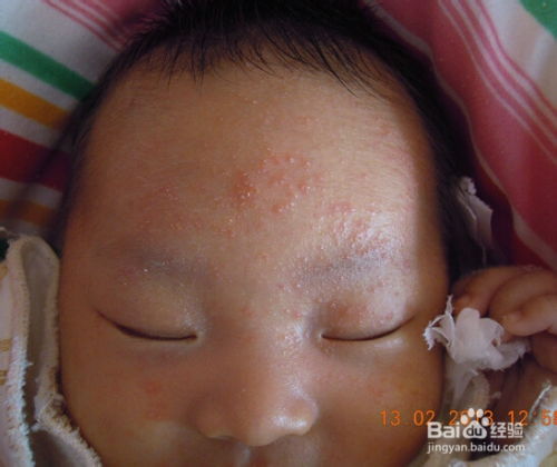 满月的婴儿额头有湿疹会哭吗,刚满月的宝宝额头有湿疹怎么办？