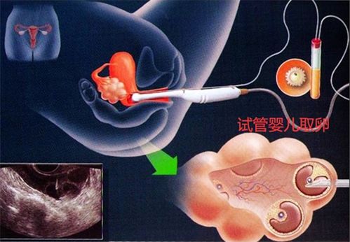 试管婴儿取卵多少正常呢 取卵后需要注意哪些事项