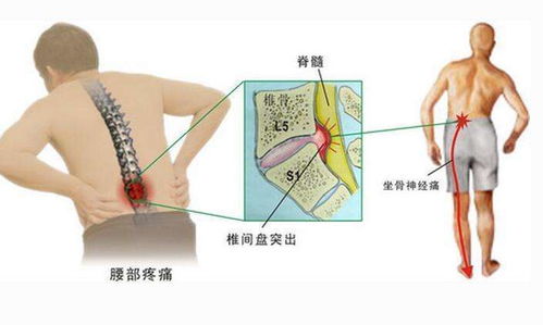 腰椎间盘突出的治疗三个要点,如何选择保守治疗或手术治疗 