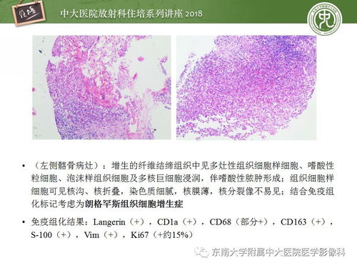 骨肿瘤及类肿瘤病变的影像诊断思路 