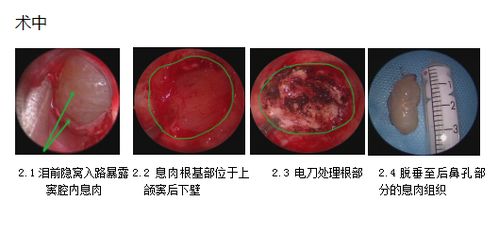 7岁男童持续鼻塞,祸首原来是 上颌窦后鼻孔息肉 