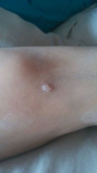 脚面伤疤里包六个白色小粒粒,是什么怎么治 