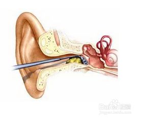 如果耳朵里有好多耵聍，自己可以挖耳朵么(耳朵里面的耵聍可以自己弄吗)