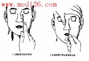 耳鼻咽喉外科学第一节 鼻骨骨折 fracture of nasal bone 课程讲解 精品课程 诊断治愈 