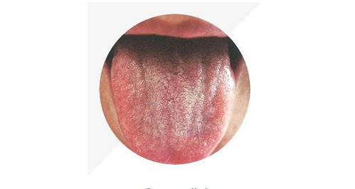 儿童舌头中间发黑图片图片