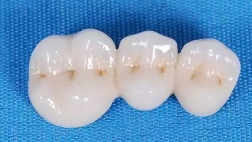 固定假牙可以用多久 医生提醒 这2种方法要注意,10年绰绰有余