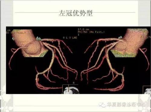  冠脉lcx是什么意思,什么是冠脉LCX ? 钱包应用