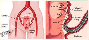 子宫动脉栓塞术 不开刀治疗子宫肌瘤