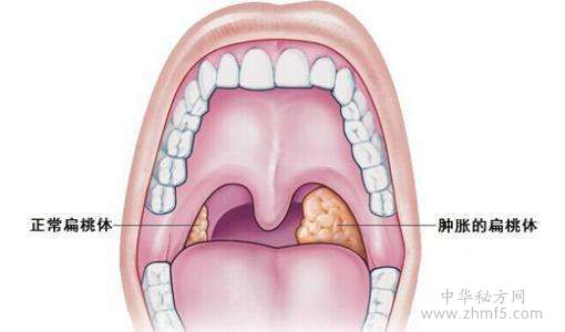 扁桃体炎偏方