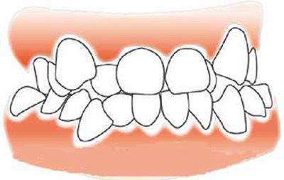 牙齿矫正必须拔牙的三类人 