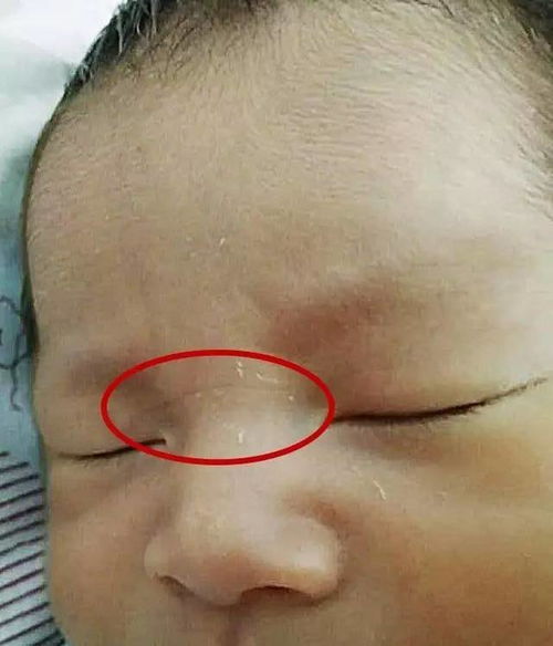 专家在线丨宝宝鼻梁上有条横纹是怎么回事 看完原因后,家长终于不用自己吓自己了 