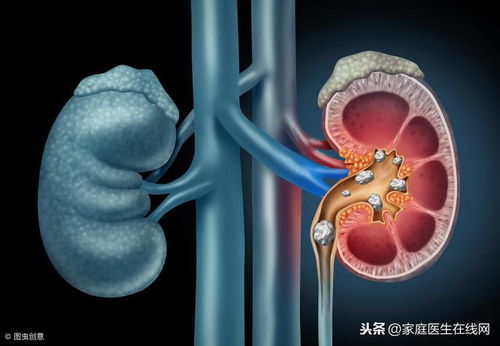 肾结石患者能喝豆浆吗 牢记这4点,以免结石继续长大