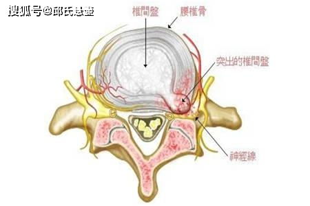 怎么避免患上腰椎间盘突出 邱氏悬壶