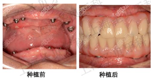  icx种植体 钱包应用