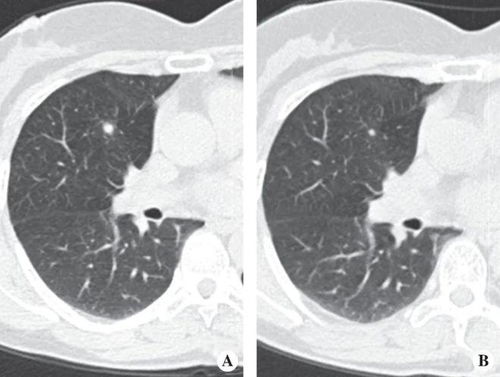 CT 筛查发现的肺结节随访过程中各种变化的临床意义